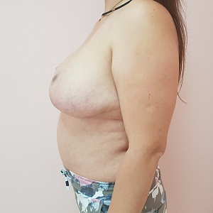 Уменьшение груди (редукционная маммопластика)