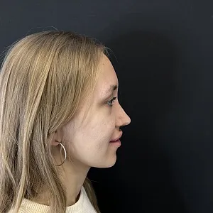 Результаты ринопластики №60