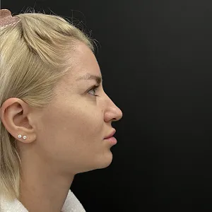 Результаты эндоскопической подтяжки лба