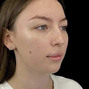 Результаты ринопластики №16