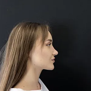 Результаты ринопластики №36