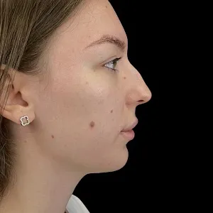 Результаты ринопластики №16