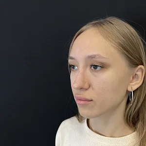 Результаты ринопластики №60