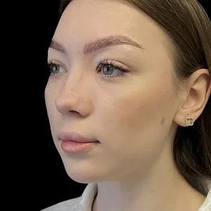 Результаты ринопластики №16