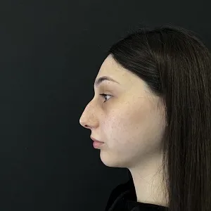 Результаты риносептопластики №4